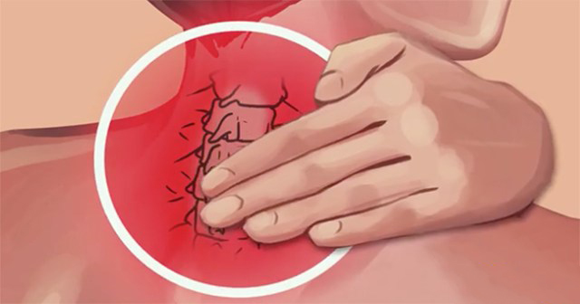 Đau cổ gáy lâu ngày không điều trị dễ dẫn đến thoái hóa